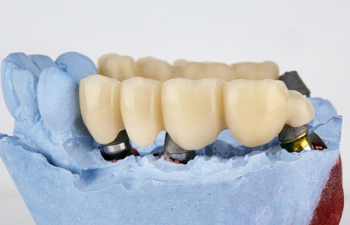 dental bridges the missing tooth